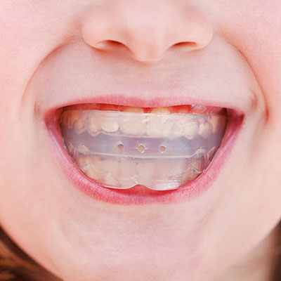 Mouthguard