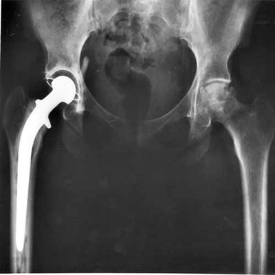 Hip Replacement