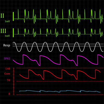 Heart Monitor