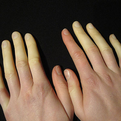 Raynauds