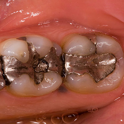 Amalgam