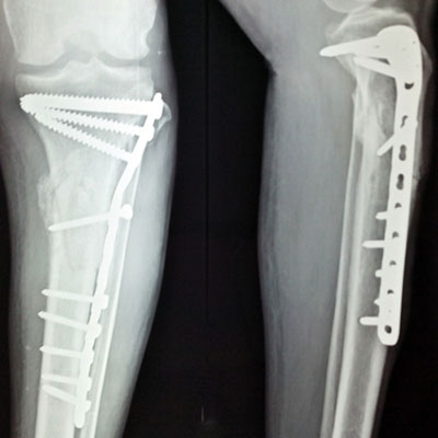  Titanium 