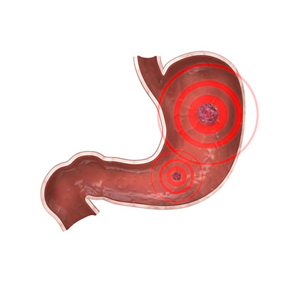  Ulcer 