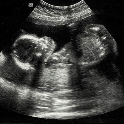 Ultrasound