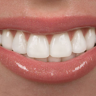 Veneers