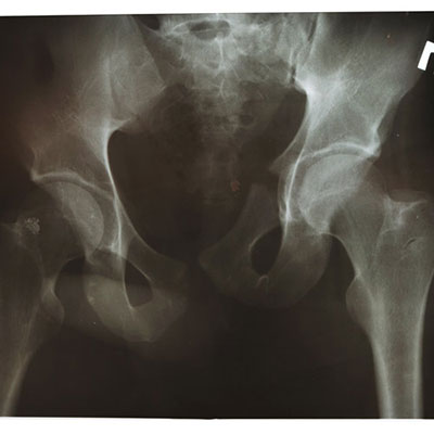  X Ray 