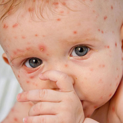 Chickenpox