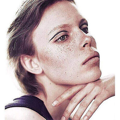 Freckles