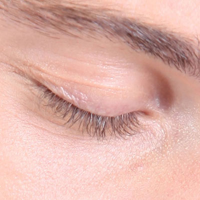  Eyelid 