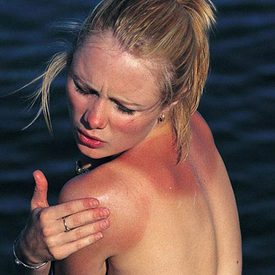 Sunburn