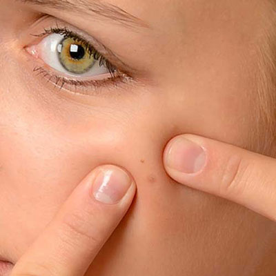 Blackhead