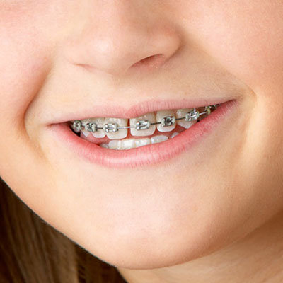 Braces