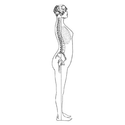 Lordosis