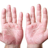  Psoriasis 