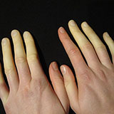  Raynauds 