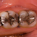  Amalgam 