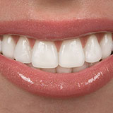  Veneers 