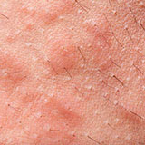  Eczema 