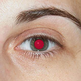  Red Reflex 