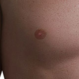  Nipple 