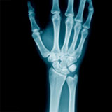  Scaphoid 